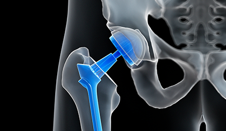 대퇴골경부골절 치료방법